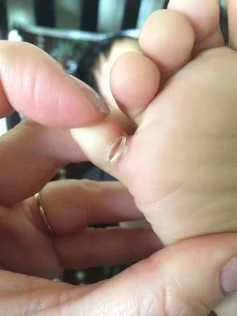 Peau fissurée sous son orteil rose