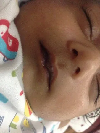 השפתיים הפנימיות של התינוק שחורות. שיא מחובר