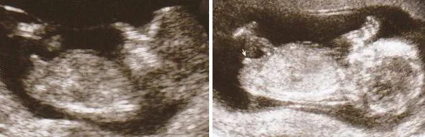 11 주에서 13 주 사이의 초음파를 생성하면 어린이의 종을 알 수 있습니까?